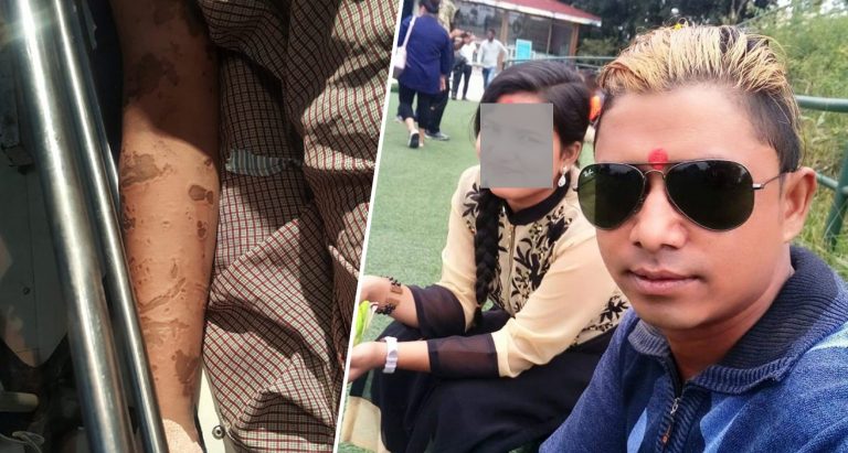आफ्नै श्रीमानकाे एसिड प्रहारबाट घाइते भएकी जेनी खड्काको स्वास्थ्य अवस्था गम्भीर