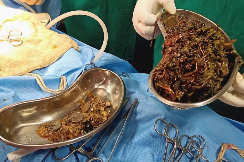 युवतीको पेटबाट निकालियो डेढ केजी गहना र सिक्का! | OmkarTimes.com